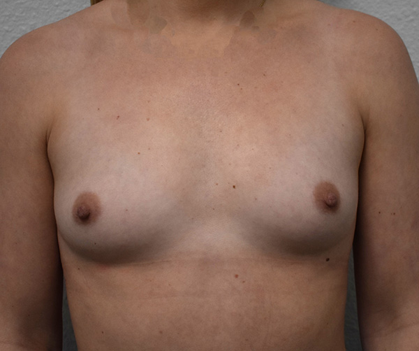 Breast Augmentation